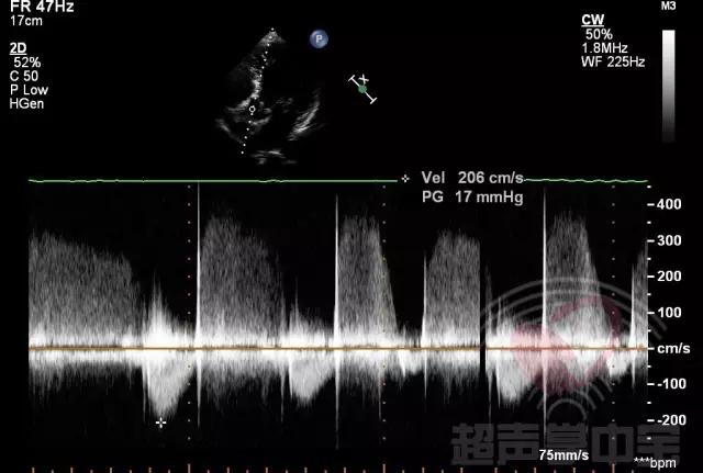 经典病例▏二尖瓣囊肿中竟然全是血液？