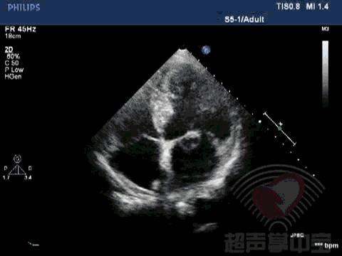 经典病例▏二尖瓣囊肿中竟然全是血液？