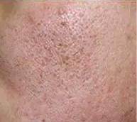 痘印的种类及成因,红色痘印成因