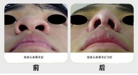 哪些人适合做鼻翼缩小,哪些人适合鼻尖整形呢