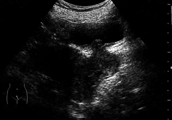 宫颈癌超声病例,宫颈癌手术病理单怎样看懂