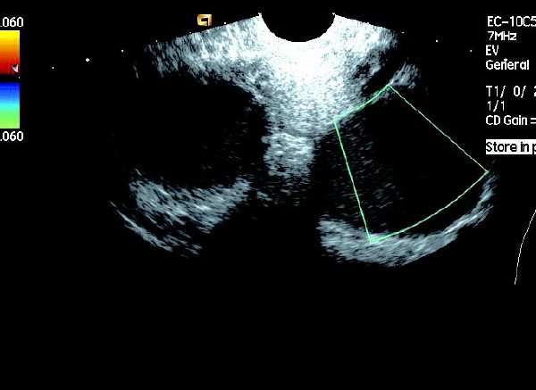 卵巢巧克力囊肿癌变的10个征兆,卵巢巧克力囊肿5.4厘米必须手术吗