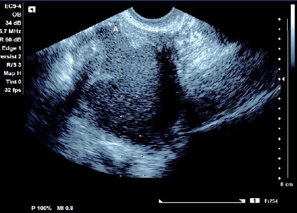 卵巢巧克力囊肿癌变的10个征兆,卵巢巧克力囊肿5.4厘米必须手术吗