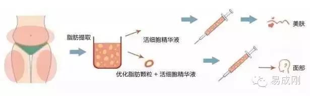 自体脂肪填充——你还在嫌弃堆积的脂肪吗?