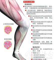 横纹肌溶解动画解说,龙虾横纹肌溶解症
