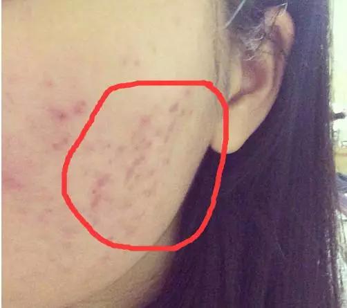 痘痘科普视频,痘痘知识科普祛痘印