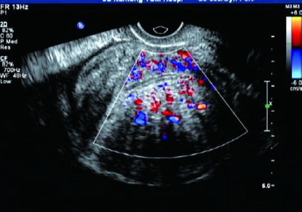 子宫内膜异位症综述,隐匿性子宫内膜异位症状