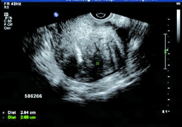 子宫内膜异位症综述,隐匿性子宫内膜异位症状