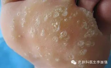 千里之行，别让跖疣止于足下！