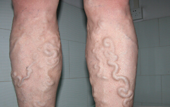 下肢静脉曲张如何预防和治疗,静脉曲张的原因及治疗或缓解方法