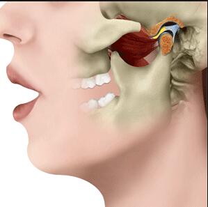 颞颌骨张口闭口咯咯响怎么办,下颌关节综合征张口闭口有弹响