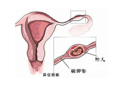 儿媳因宫外孕不能有身孕,儿媳妇有宫外孕怕婆婆知道