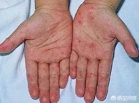 慢肝是什么病,肝脏不好有什么症状表现在脸上