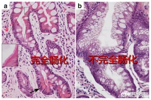 肠上皮化生能治好吗会变癌吗,肠上皮化生可以治愈吗