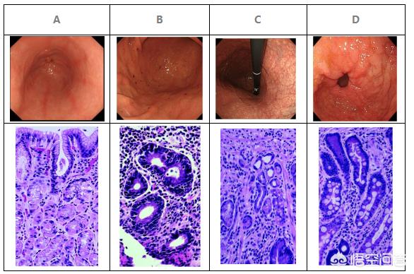 肠上皮化生能治好吗会变癌吗,肠上皮化生可以治愈吗