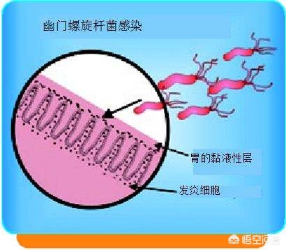肠上皮化生能治好吗会变癌吗,肠上皮化生可以治愈吗