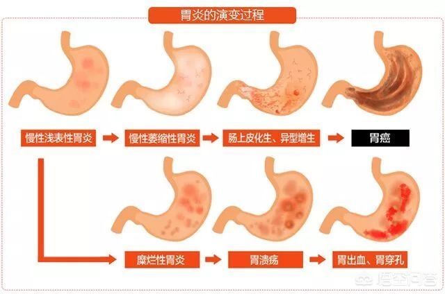 肠上皮化生能治好吗会变癌吗,肠上皮化生可以治愈吗