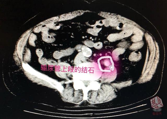 排石中药吃了一年多了,吃排石的药尿液浑浊黄