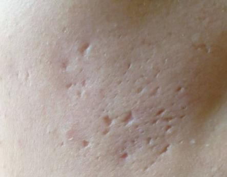 脸上的痘坑怎么修复啊,脸上的痘坑怎么修复呀