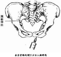 孕妇顺产侧切一般多少天恢复,顺产侧切和撕裂哪个好恢复