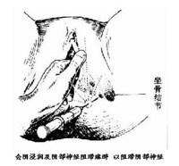 孕妇顺产侧切一般多少天恢复,顺产侧切和撕裂哪个好恢复