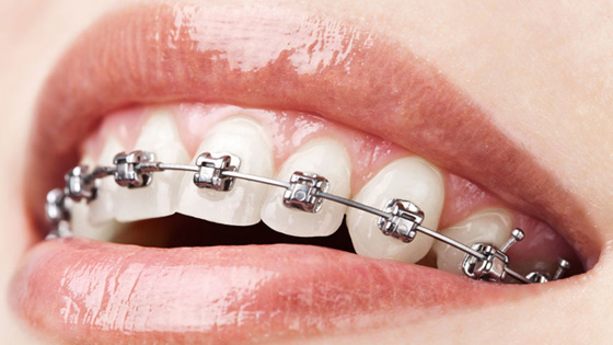 矫正牙你不知道的内幕,矫牙是一件没意义的事