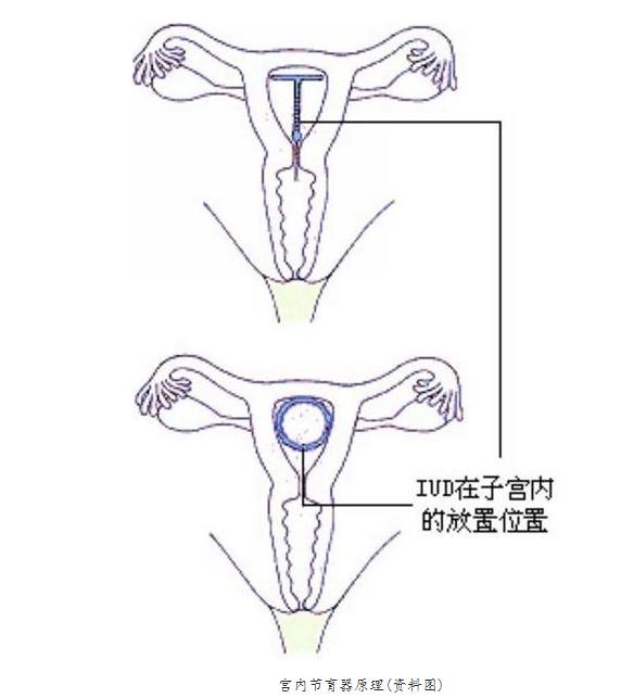 你被逼上环了吗？女性上环全过程，简直就像命案现场！