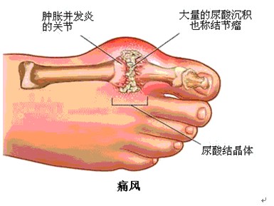 倪海厦治疗痛风中药处方用法,痛风用什么中药调理代谢功能