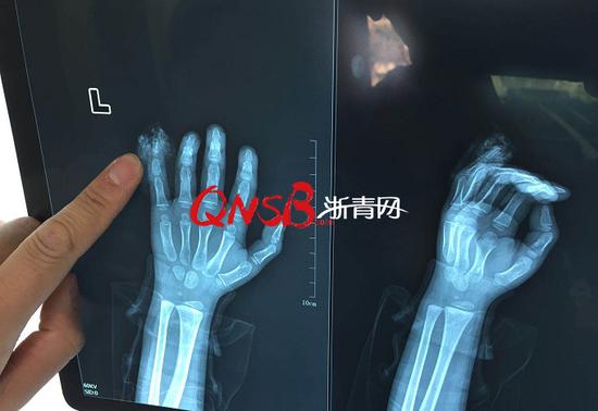 灏忓鎶婅烦缁冲す鍦ㄧ數姊噷鎵嬭鎷夋柇,7宀佺敺瀛╃帺鑰嶆妸鎵嬮敮鏂簡