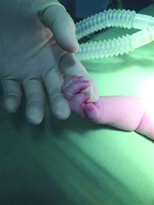 婴儿颅内出血开颅手术,婴儿颅内出血破入脑室