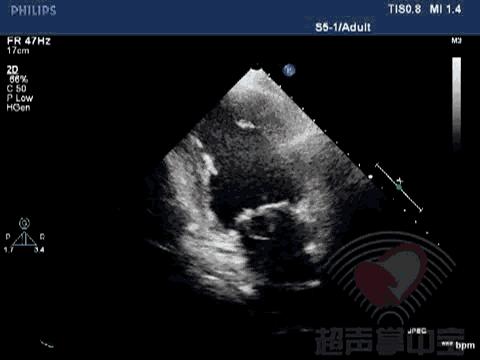 经典病例▏二尖瓣囊肿中竟然全是血液？