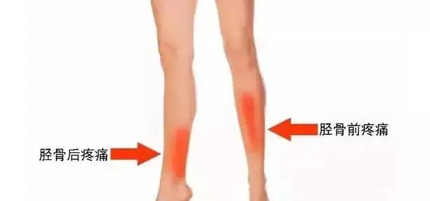 小腿前面疼痛还能继续跑步吗？