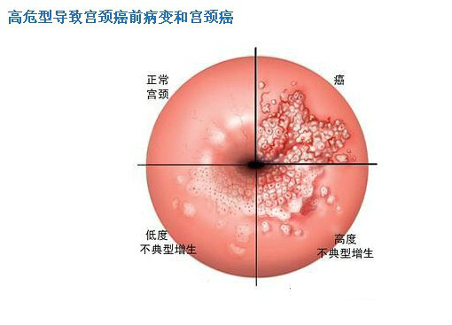 hpv常见问题和解决讲解,hpv常见问题及解决方法