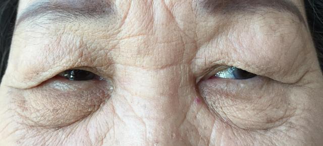 如何去除眼袋皱纹?养成好眼部的护理习惯