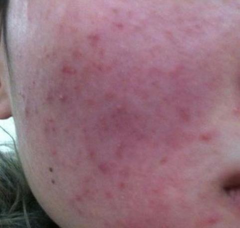 油敏感肌与干敏感肌的区别,不敏感皮可以用敏感护肤品吗