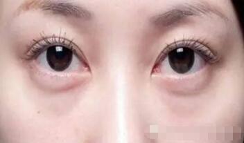 如何去除眼袋皱纹?养成好眼部的护理习惯