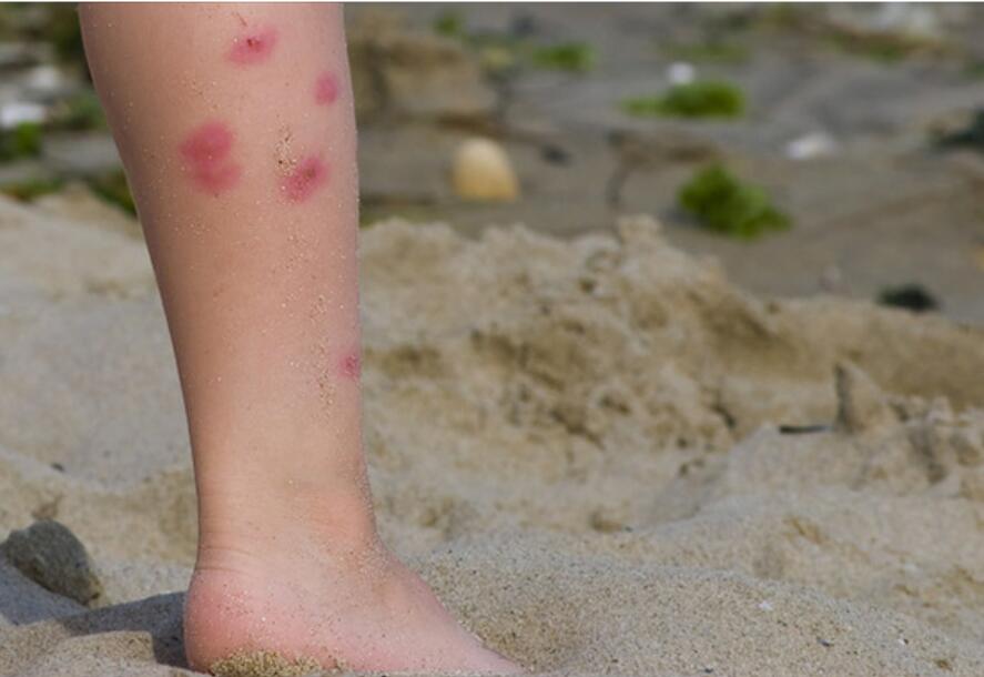 当妈的因为不知道这个，儿子被蚊子叮咬后……