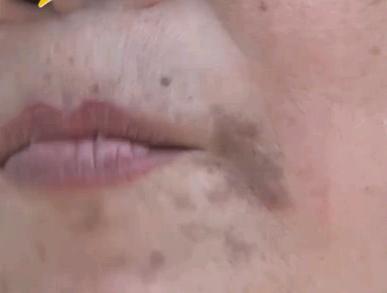 月季哪些因素会引起黑斑,黑斑是怎么造成的