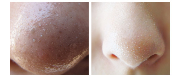 最温和的去黑头方法,去黑头闭口痘痘最好方法