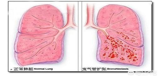 什么是支气管囊状扩张,支气管扩张肺部纹理变粗