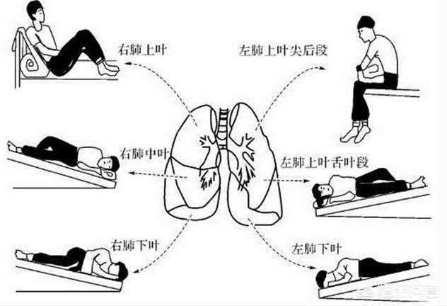 什么是支气管囊状扩张,支气管扩张肺部纹理变粗