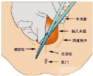 顺产什么情况需要会阴侧切？