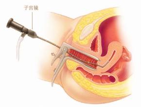 宫内感染能治好吗,宫内感染巨细胞发病的几率是多少