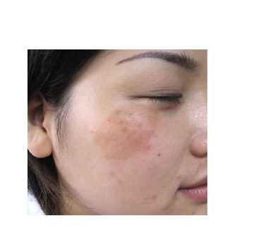 药吃多了会长色斑吗,反复刺激色斑