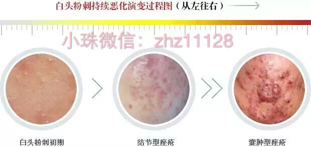 白头粉刺和炎症丘疹的区别,粉刺结节的最佳治疗方法