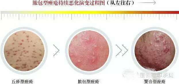 白头粉刺和炎症丘疹的区别,粉刺结节的最佳治疗方法