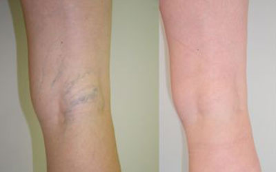 李玉华西医诊所,丹东张爱华治疗静脉曲张