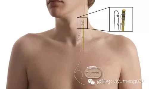 难治性抑郁症到底怎么治,7种抑郁症的最佳治疗方法