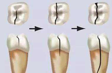牙隐裂有多少人,牙隐裂算几级伤