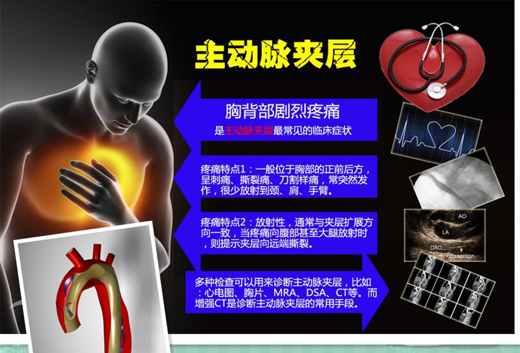 主动脉夹层通俗易懂的说法,主动脉夹层最终是怎样致命的